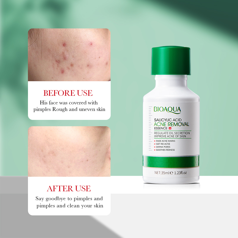35 мл BIOAOUA Салициловая кисл – обзор и цена Salicylic Acid Blackhead Remover